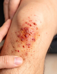 Fototapeta premium A close-up of granulated skin forming unevenly around an infected wound on a man�s leg with discoloration.
