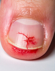 A detailed view of cracked, oozing skin around a nail wound surrounded by redness and swelling.