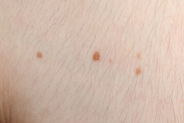 Woman with moles on her body, closeup