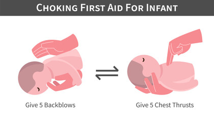 Choking First Aid For Infant cartoon illustration . Back blows and switch with chest thrusts . Flat design . Vector .