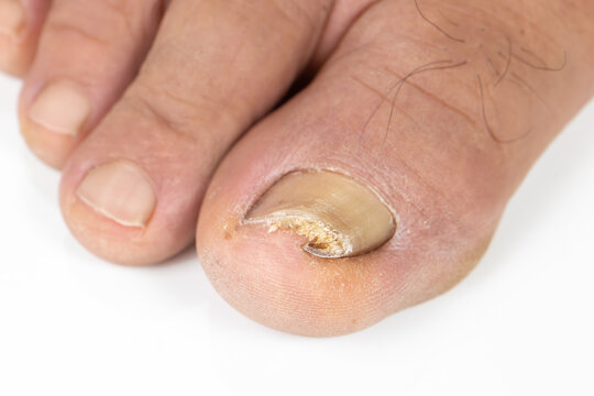 Ingrown toenail on a senior feet with white background
Close-up ingrown toenail on senior feet with white background.