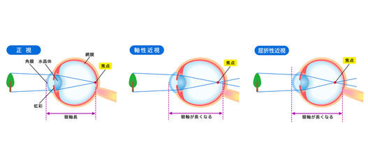 目の構造　正視　軸性近視　屈折性近視　視力