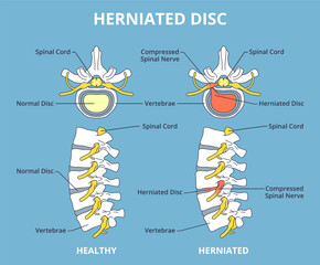Herniated disc. Sick and healthy spine, medical comparison scheme, nerve compression structure, inflammatory process, back pain, injury and trauma, nowaday vector infographics banner design