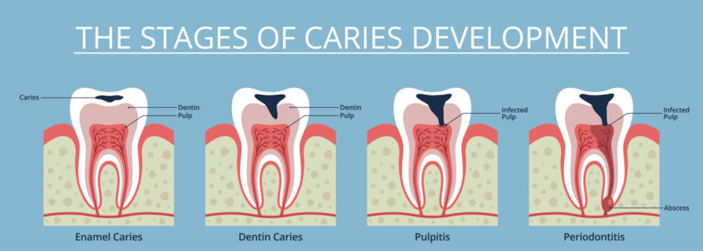 Caries stages. Gradual tooth decay process, enamel integrity violation, dental educational scheme, toothache medical poster, stomatology clinic infographics banner nowaday vector concept