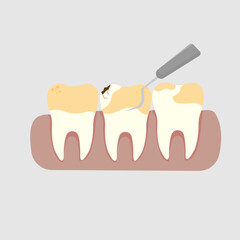vector illustration of cleaning tartar on teeth with a special tool