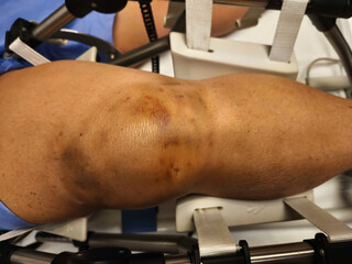 CPM Device Physical Therapy for Post-Operative Knee Joint Patients. Post-Surgical Knee...