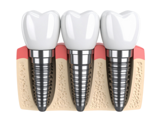Tooth implant model with three crowns 3d illustration isolated on transparent or white background, png