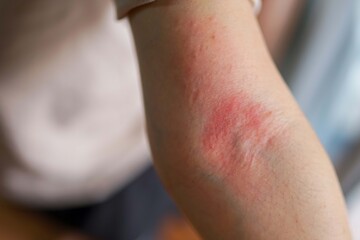 Asian woman has red rash on her right arm 
