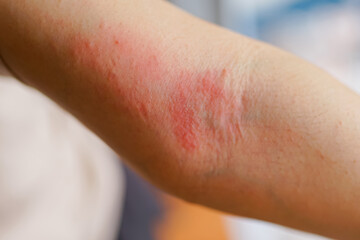 Sensitive skin allergic concept, Woman itching on her arm have a red rash from allergy symptom and from scratching. 
