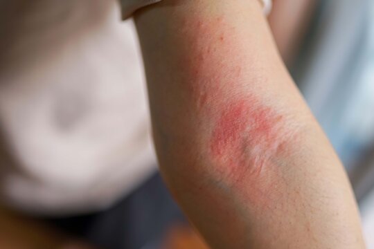 Asian woman has red rash on her right arm 
