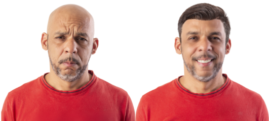 40-year-old man showing before and after bald and with hair implant