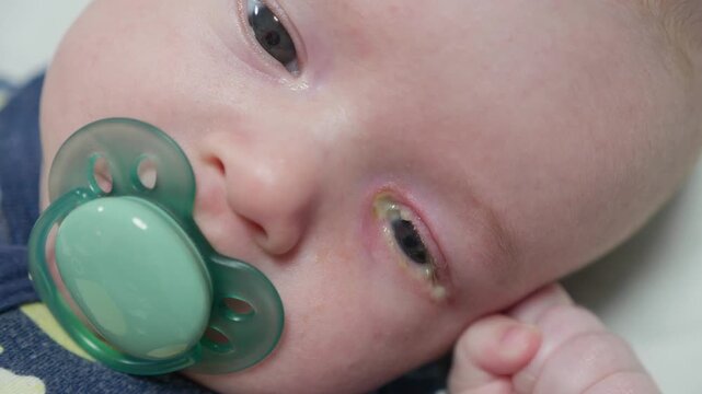 Baby eyes with eye mucus in selective focus. Disease tear ducts tons of newborns close up. Nasolacrimal duct obstruction in baby it is a blockage of the lacrimal drainage system. 