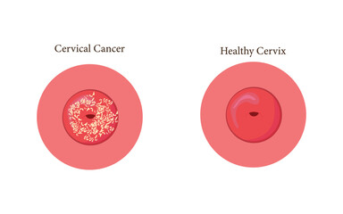 Anatomical diagram showing cervical cancer next to normal cervix structure. eps 10
