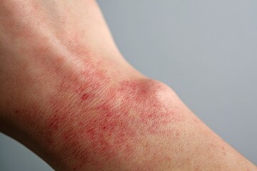 Red itchy skin spots may signal psoriasis a hereditary immune disorder that often causes discomfort