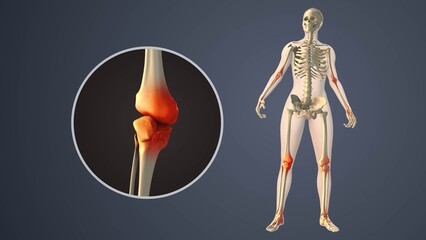 Degenerative Arthritis Affecting Inner knee Joint Spaces