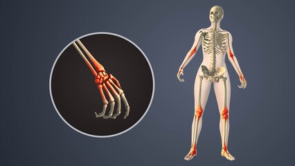 Degenerative Arthritis Affecting Inner wrist Joint Spaces
