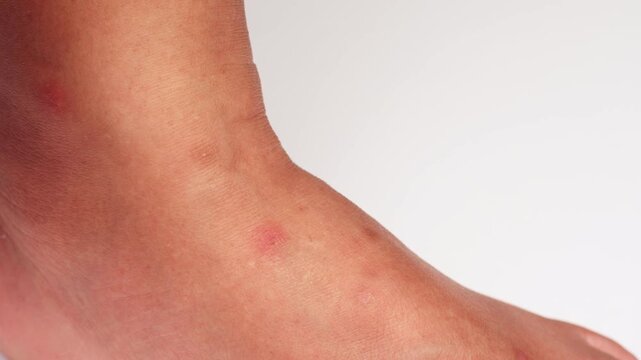 Close up view of flea bites on lower legs and feet skin.