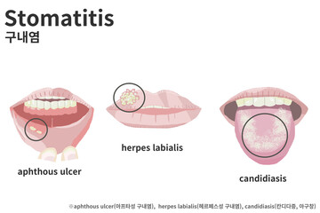 stomatitis (구내염)