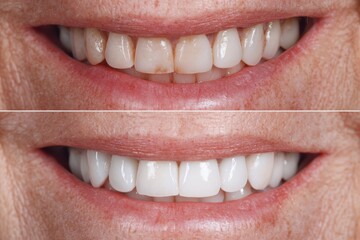 Fototapeta premium Create a Photo of Teeth Treatment at a Dentist - Before and After Teeth Whitening.