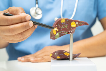 Cirrhosis, Liver cancer, fatty liver, Asian doctor with liver human anatomy model in World...
