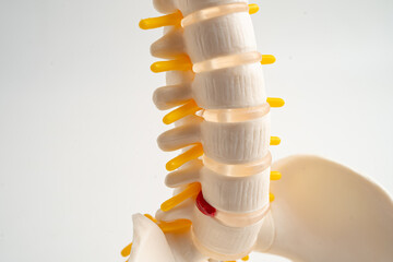 Lumbar spine displaced herniated disc fragment, spinal nerve and bone. Model for treatment medical...