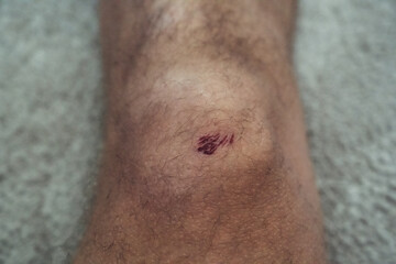 A little grazing wound on the knee