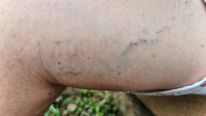 Fototapeta premium Close-up of skin showing spider veins, small, visible blood vessels near the surface. These appear as fine lines or web-like patterns, often bluish or reddish in color.