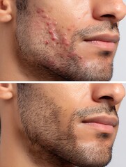 Fototapeta premium Comparison of the chin skin of Latino men with acne before and after treatment, suitable for acne treatment brands or anti-inflammatory gels.