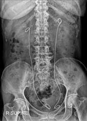 Urological Radiograph Demonstrating Double-J Stent Placement