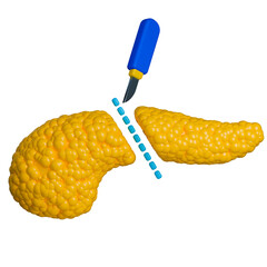 Pancreatectomy 3d illustration, with scalpel cutting pancreas.