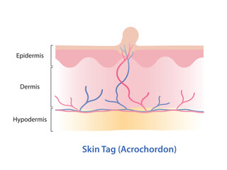 Infographic of skin tag vector illustration. Skin tag is small excess piece of skin that protrude from surface skin, often grow on neck, armpits, eyelid, under breast, groin, thigh and genital.