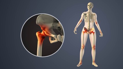 Degenerative Arthritis Affecting Inner Hip Joint Spaces