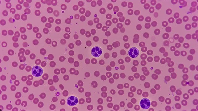 Blood Hematology -Thrombocytopenia (low platelets in blood smear)