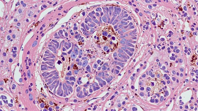 Histopathology - Glioblastoma multiforme (brain tumor)