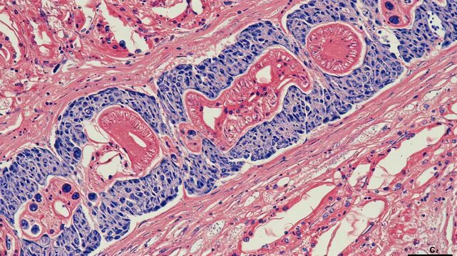 Neuropathology - Spinal cord lesion cross-section