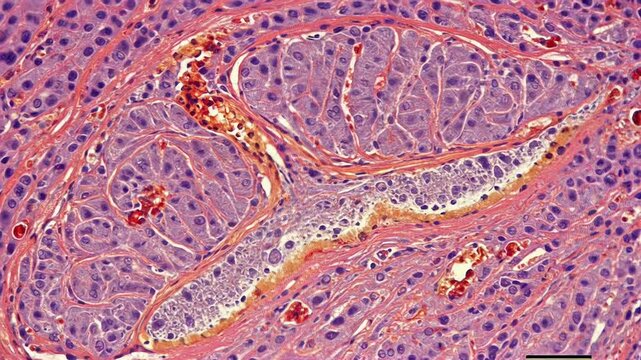 Neuropathology - Multiple sclerosis (demyelination in brain tissue)