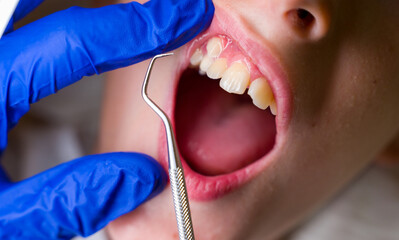 Open mouth of a boy showing a moved up tooth in dentist