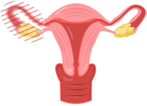 Salpingo Oophorectomy 