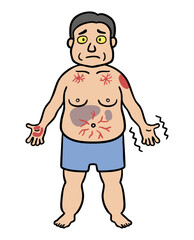 肝硬変の症状を呈する中年男性のイラスト
