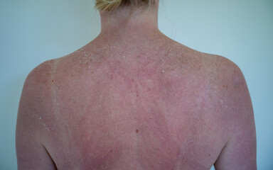 Fototapeta premium Sunburned back of a woman with peeling skin after sun exposure