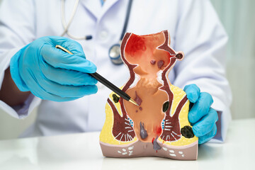 Asian doctor with rectum and hemorrhoid human anatomy model at hospital, inflamed vascular...
