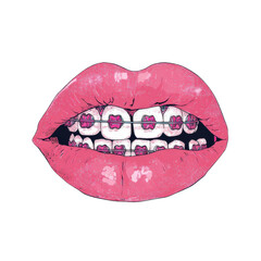 Pink Lips and Orthodontic Brilliance: A close-up view of a person's lips, adorned with vibrant pink lipstick, showcasing a full set of teeth and meticulously crafted orthodontic braces