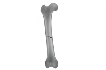 Broken bone fracture with transparent background medical illustration