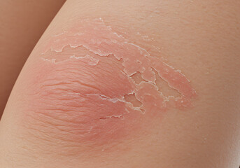 Fototapeta premium Skin irritation closeup
