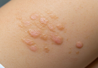 Fototapeta premium Skin irritation lesions closeup