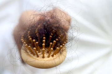 Hair loss in the center of the head or along the forehead