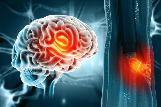 Brain tumor or barin cancer. 3d illustration