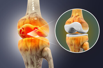 Knee Joint Replacement Surgery. 3d illustration