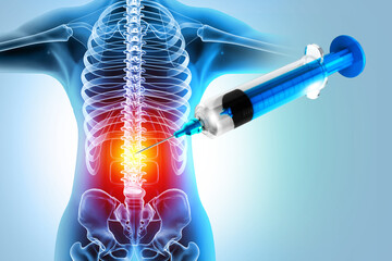 3d illustration of a lumbar spine injection