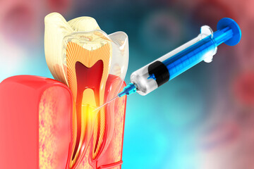 Dental injection. local Dental anesthesia. 3d illustration